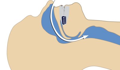 With SnoreMD, the lower jaw is advanced slightly forward to open the airway